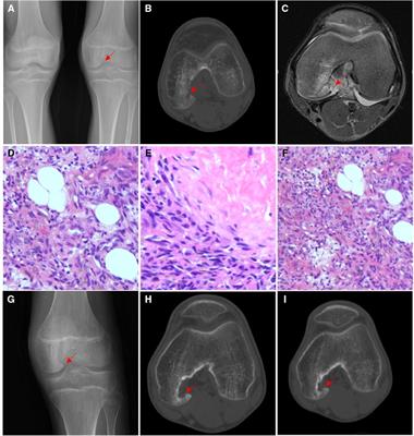 Clinical manifestations and imaging and pathological features of giant cell angioblastoma: Report of four cases and literature review